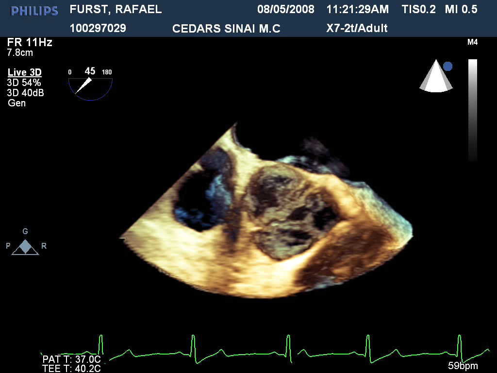 ct-valve-top-still1 ct-valve-top-still1